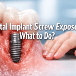 Dental Implant Screw Exposed – What to Do?