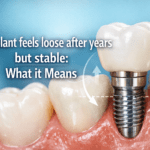 Implant feels loose after years but stable
