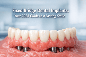 fixed bridge dental implants