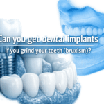 Can you get dental implants if you grind your teeth (bruxism)?