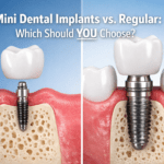 Mini dental implants vs regular implants: which should I choose?